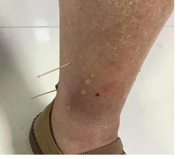 針灸治療