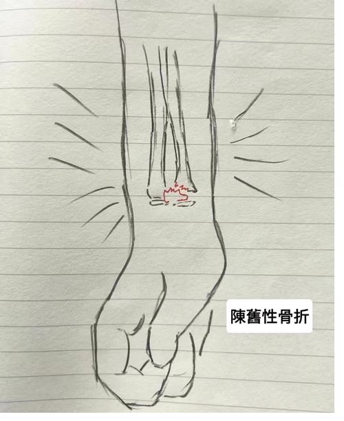 陳舊性骨折、骨折不癒合