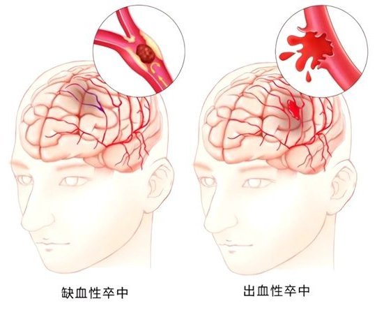中風成因示意