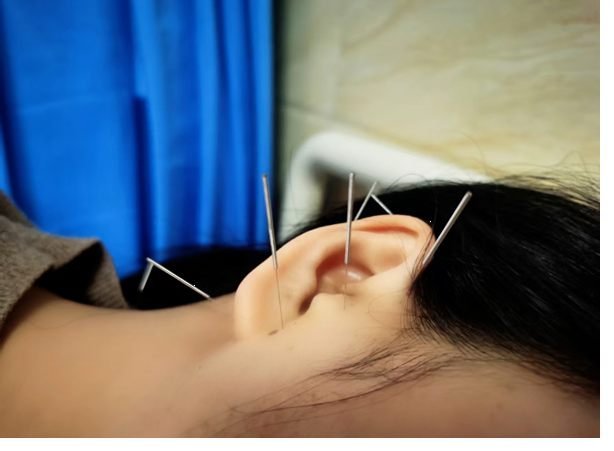 針刺療法調節經絡氣血